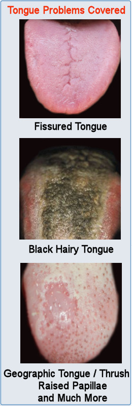 Tongue Problems: Fissured Tongue, Black Hairy Tongue and Geographic Tongue - Thrush Raised Papillae and Much More