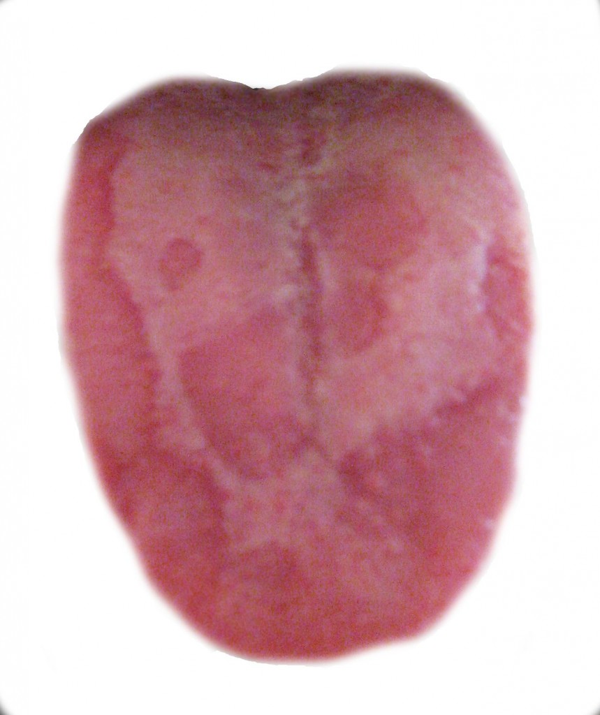 Geographic Tongue What is it?