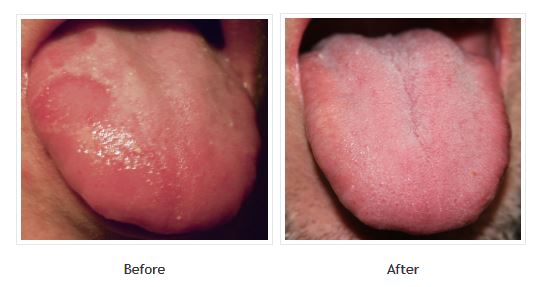 My Geographic Tongue Before and After